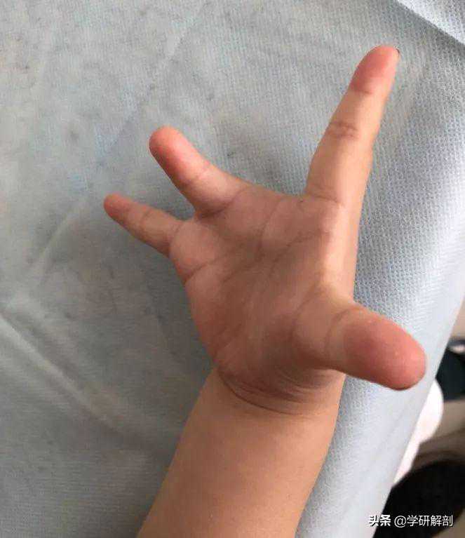 宝宝生下来只有4根手指，手指畸形这样的事情该如何避免